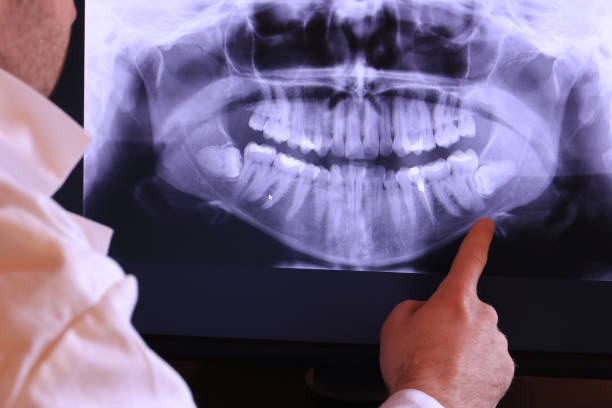 Best Emergency Dental Extractions in Beresford, SD